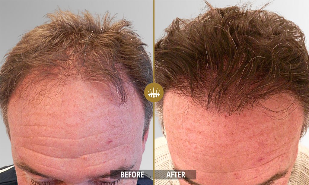 Hasci Method Hair Science Clinic - The World Leader in Hair Transplants