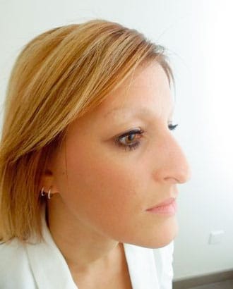 Eyebrows before hairtransplantation