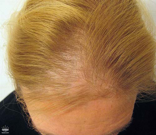 Hair loss in woman for hair transplant