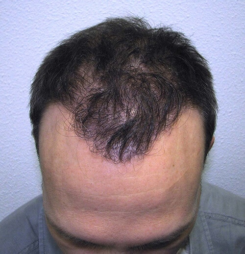 Haargrens na haartransplantatie