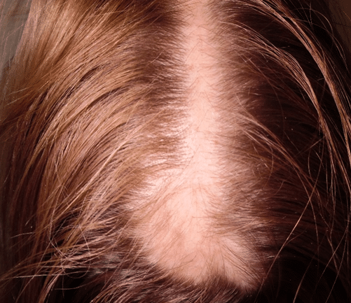 litteken voor haartransplantatie