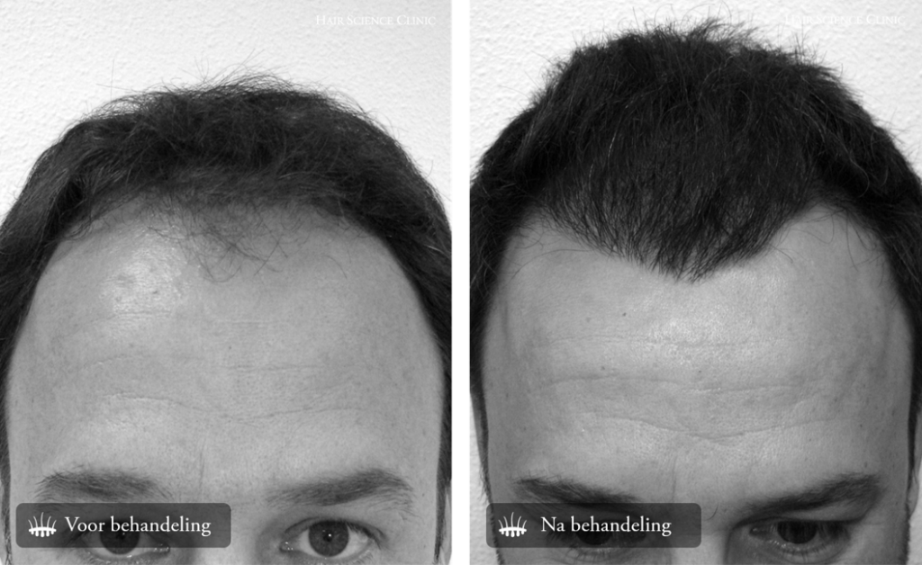 Hair Transplant Before & After Photos - Unfiltered Results Gallery