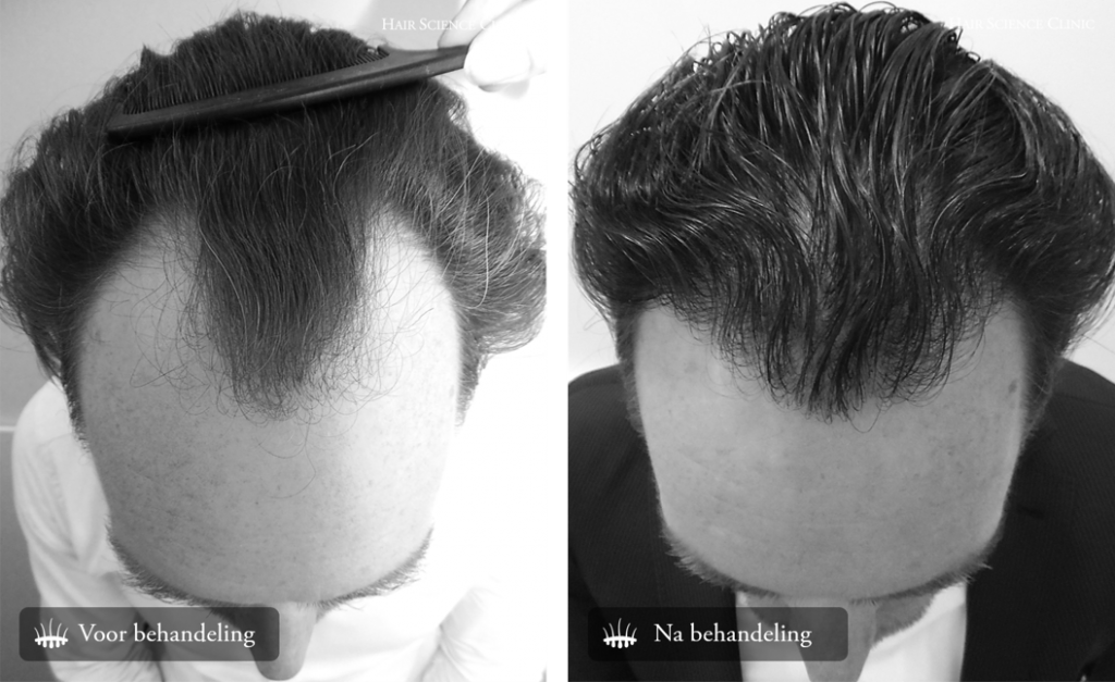 Hair Science Clinics - Hair Transplant Before and After Pictures