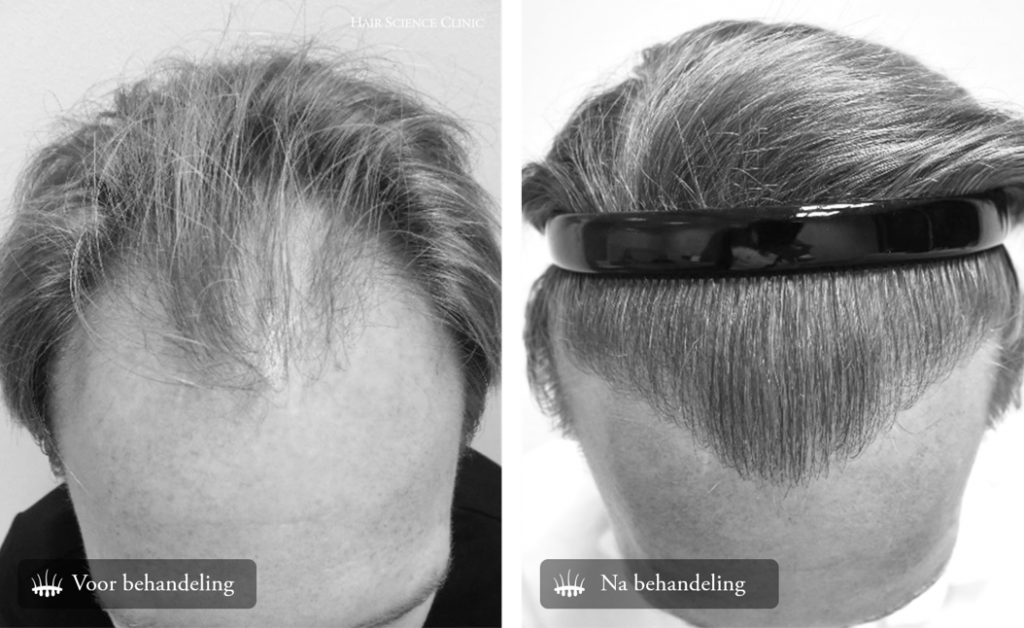 Hair Science Clinics - Hair Transplant Before and After Pictures
