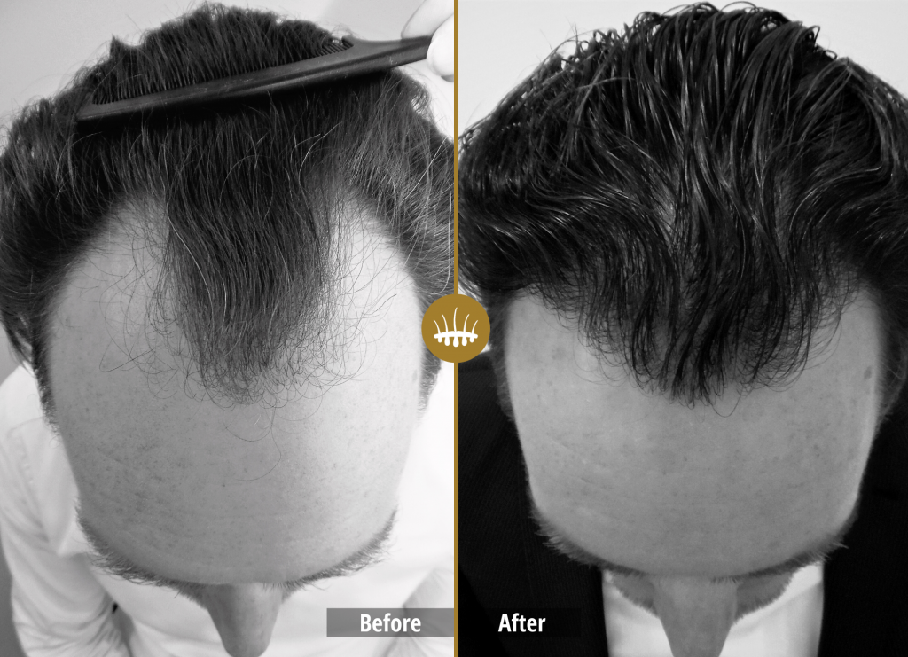 Hair Science Clinic- the world leader in hair transplantation!