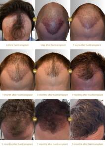 Results hair transplant Hair Science Clinic 