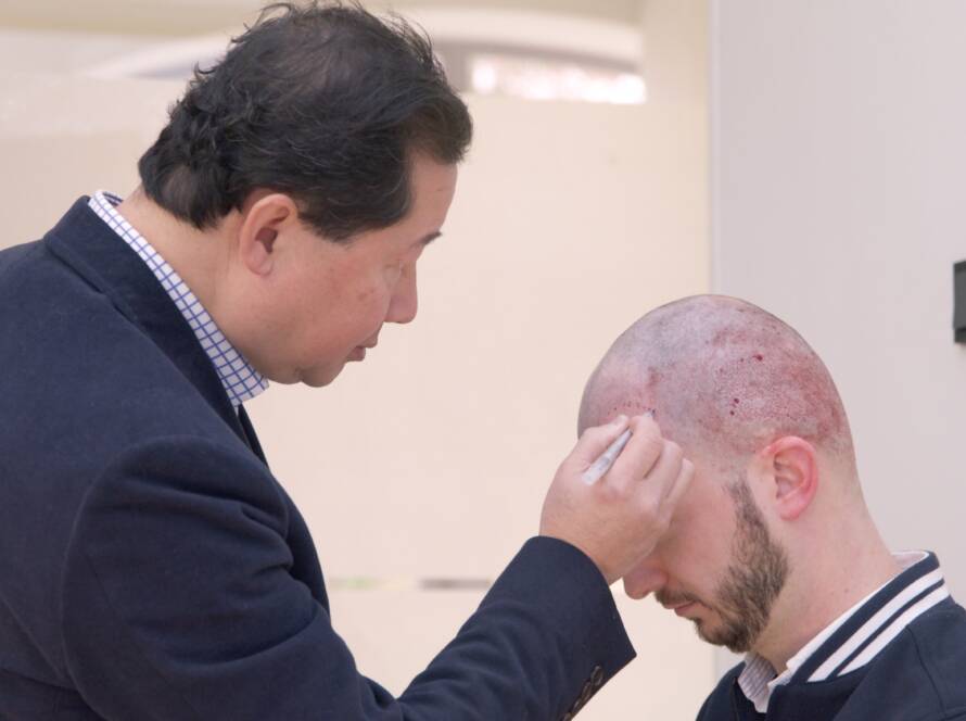 Experience blog: Jeroen's hair transplant