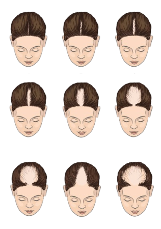 vrouwelijk-patroon-van-haaruitval-.png Female hair loss