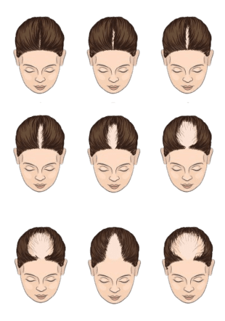 Female hair loss