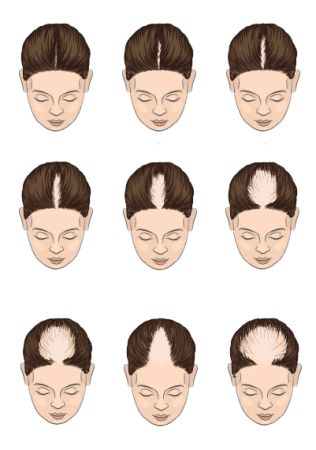 Female hair loss